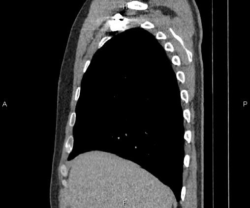 Bilateral pulmonary AVM (Radiopaedia 83134-97505 D 32).jpg
