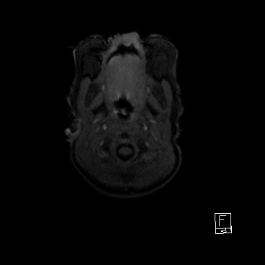 File:Bilateral subdural hemorrhage and parietal skull fracture (Radiopaedia 26058-26190 Axial T1 1).png