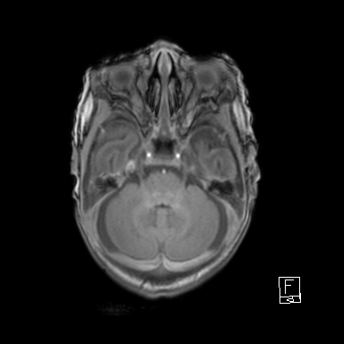 Bilateral subdural hemorrhage and parietal skull fracture (Radiopaedia 26058-26190 Axial T1 13).png