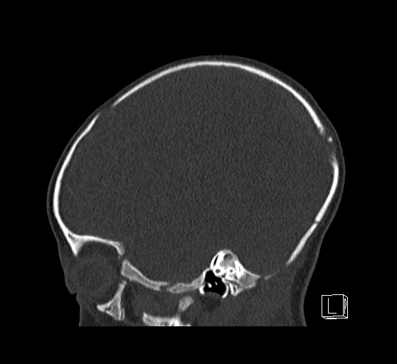 File:Bilateral subdural hemorrhage and parietal skull fracture (Radiopaedia 26058-26192 Sagittal bone window 23).png
