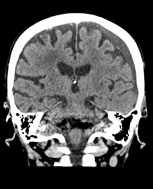Bilateral subdural hygroma (Radiopaedia 73637-84421 Coronal non-contrast 30).jpg