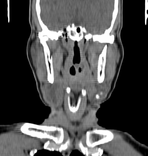 Bilateral submandibular sialolithiasis with sialadenitis (Radiopaedia 70721-80881 Coronal non-contrast 44).jpg