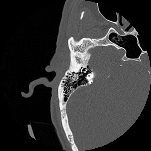 File:Bilateral temporal bone fractures (Radiopaedia 29482-29970 Axial non-contrast 38).jpg