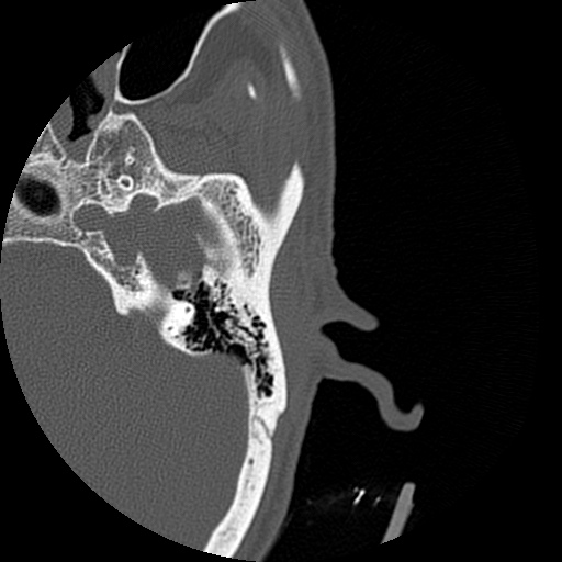 Bilateral temporal bone fractures (Radiopaedia 29482-29970 D 93).jpg