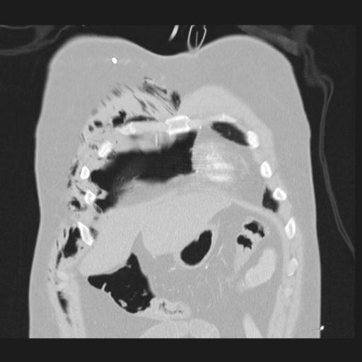 Bilateral traumatic renovascular injury (Radiopaedia 32051-32995 Coronal lung window 14).jpg