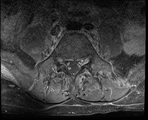 File:Bing-Neel syndrome (Radiopaedia 71453-81799 Axial T1 C+ fat sat 13).jpg