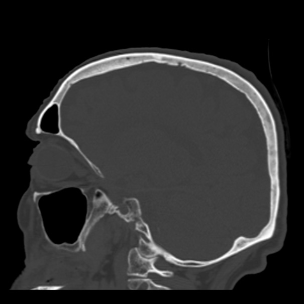Biparietal osteodystrophy (Radiopaedia 46109-50463 Sagittal bone window 42).jpg
