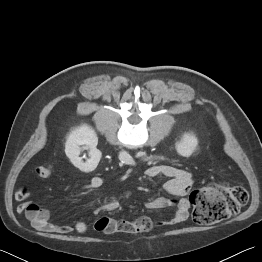File:Bladder papillary urothelial carcinoma (Radiopaedia 48119-52951 Axial C+ delayed 25).png
