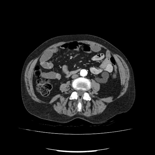 Bladder tumor detected on trauma CT (Radiopaedia 51809-57609 A 127).jpg