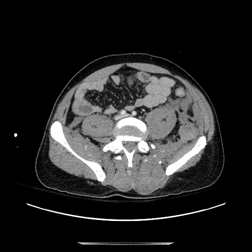 Blunt abdominal trauma with solid organ and musculoskelatal injury with active extravasation (Radiopaedia 68364-77895 A 105).jpg