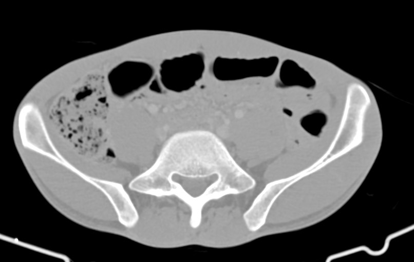 Blunt injury to the small bowel (Radiopaedia 74953-85987 Axial Wide 67).jpg