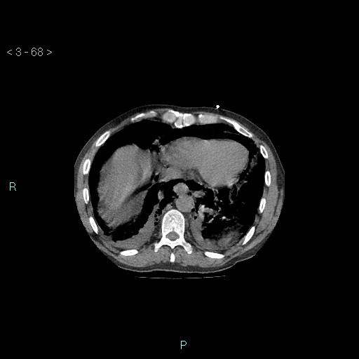 File:Boerhaave syndrome (Radiopaedia 27683-27897 Axial non-contrast 68).jpg