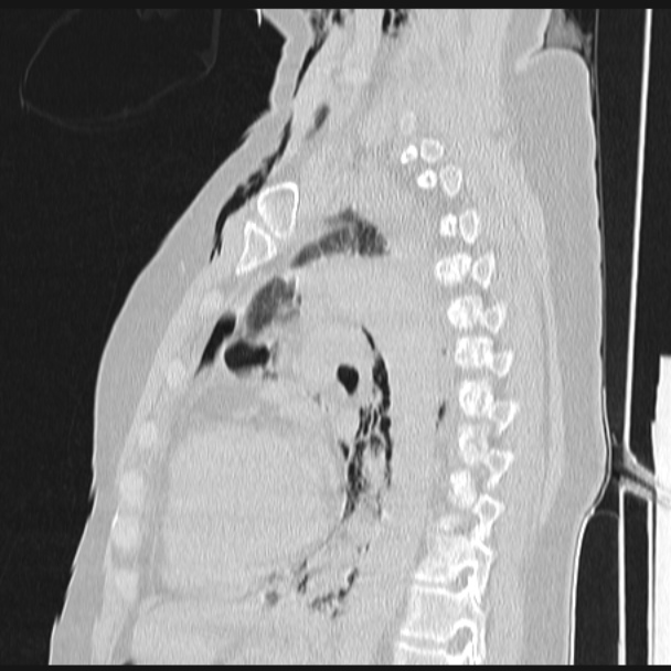 Boerhaave syndrome (Radiopaedia 45644-49799 Sagittal lung window 50).jpg