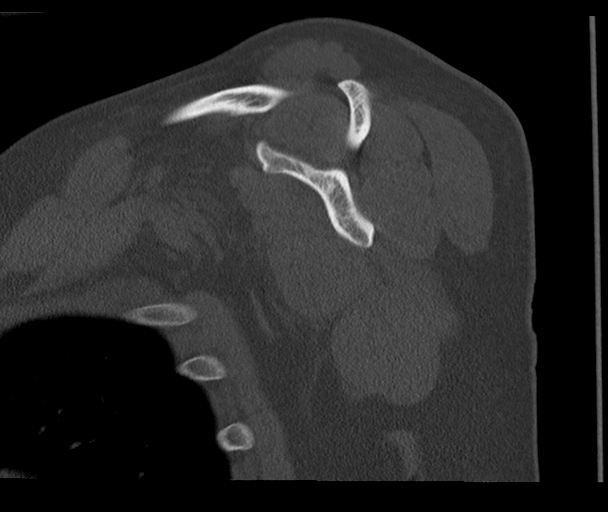 Bony Bankart and Hill-Sachs lesions (Radiopaedia 33622-34727 Sagittal bone window 37).png
