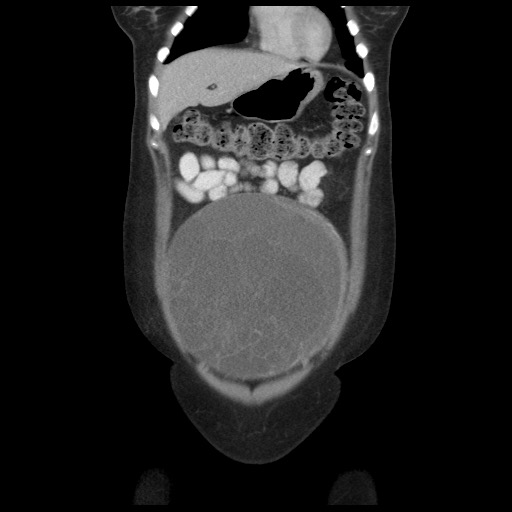 Borderline mucinous tumor (ovary) (Radiopaedia 78228-90808 C 14).jpg