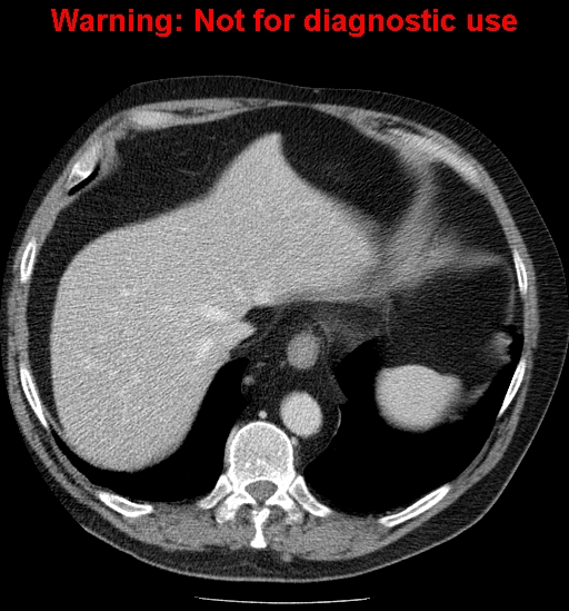 File:Bosniak renal cyst - type IV (Radiopaedia 23402-23466 D 8).jpg