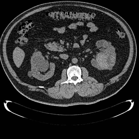 Bosniak renal cyst - type IV (Radiopaedia 24244-24518 Axial non-contrast 146).jpg