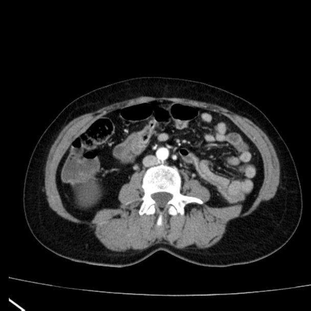 Bosniak renal cyst - type I (Radiopaedia 27479-27675 renal cortical phase 49).jpg