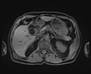 Bouveret syndrome (Radiopaedia 61017-68856 Axial T1 fat sat 29).jpg