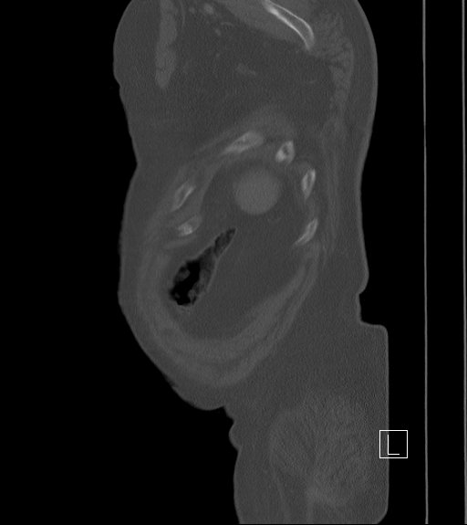 Bowel ischemia secondary to SMA occlusion with extensive portomesenteric venous gas (Radiopaedia 54656-60871 Sagittal bone window 6).jpg