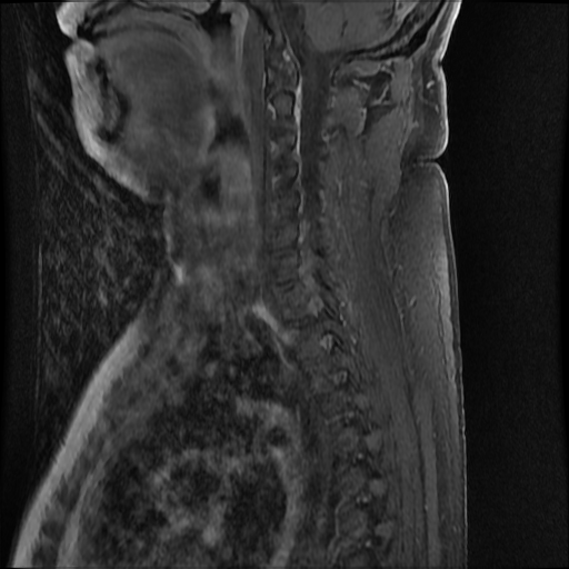 File:Brachial plexus neurofibroma (Radiopaedia 28030-28291 T1 C+ fat sat 9).png