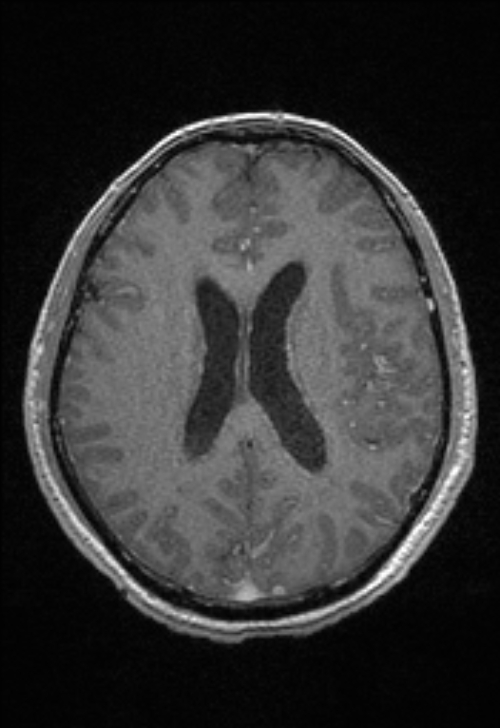 Brain abscess with ventriculitis (Radiopaedia 85703-101495 Axial T1 C+ 111).jpg