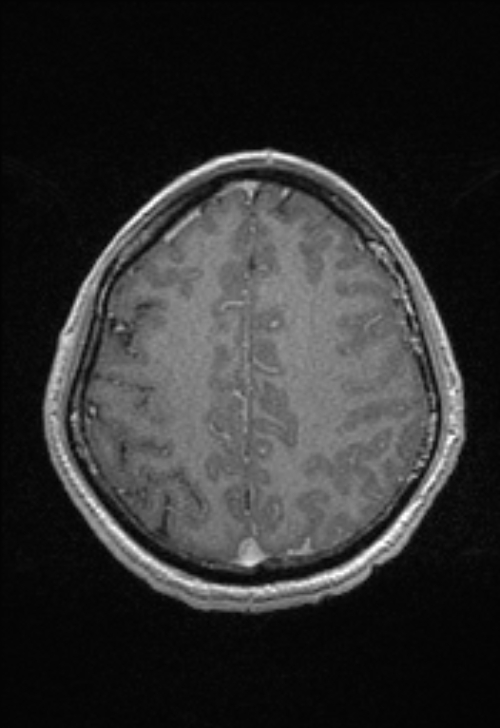 Brain abscess with ventriculitis (Radiopaedia 85703-101495 Axial T1 C+ 131).jpg