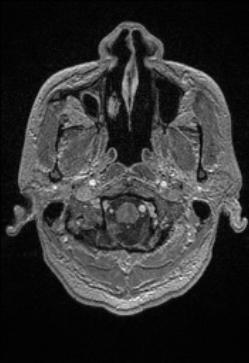 Brain abscess with ventriculitis (Radiopaedia 85703-101495 Axial T1 C+ 23).jpg