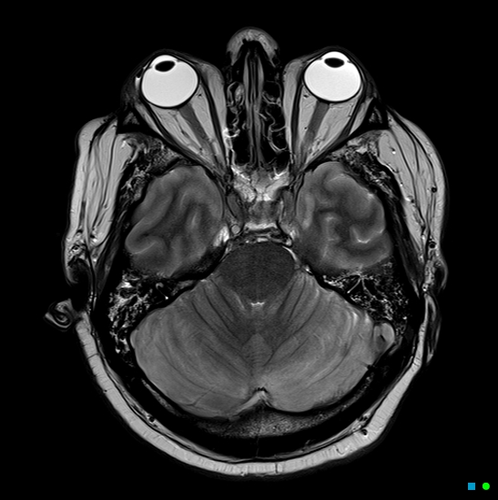 File:Brain death on MRI and CT angiography (Radiopaedia 42560-45689 Axial T2 11).jpg