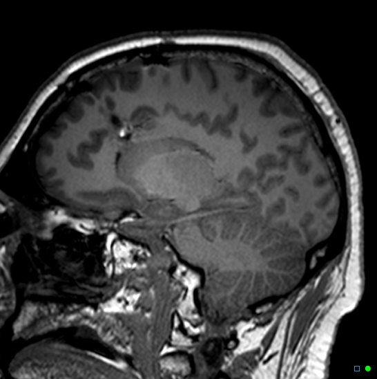 Brain death on MRI and CT angiography (Radiopaedia 42560-45689 Sagittal T1 38).jpg