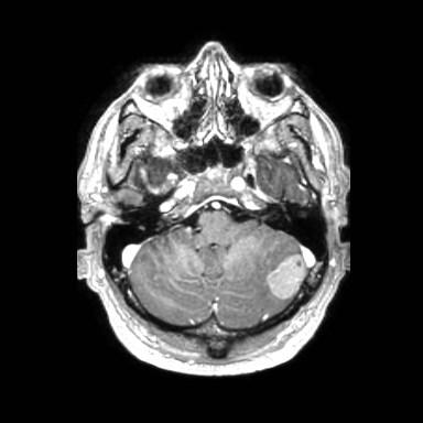 File:Brain metastases from lung cancer (Radiopaedia 83839-99028 Axial T1 C+ 10).jpg
