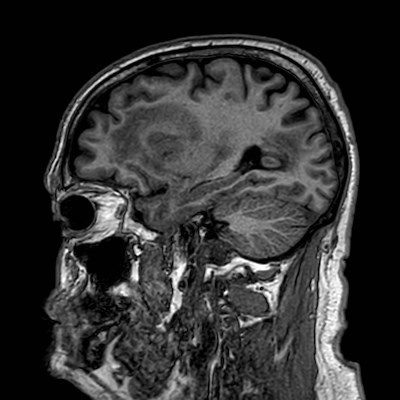 Brain metastases from lung cancer (Radiopaedia 83839-99028 Sagittal T1 38).jpg