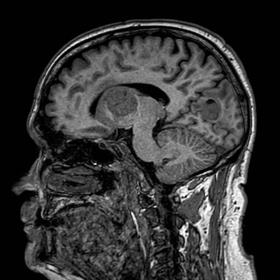 Brain metastases from lung cancer (Radiopaedia 83839-99028 Sagittal T1 54).jpg