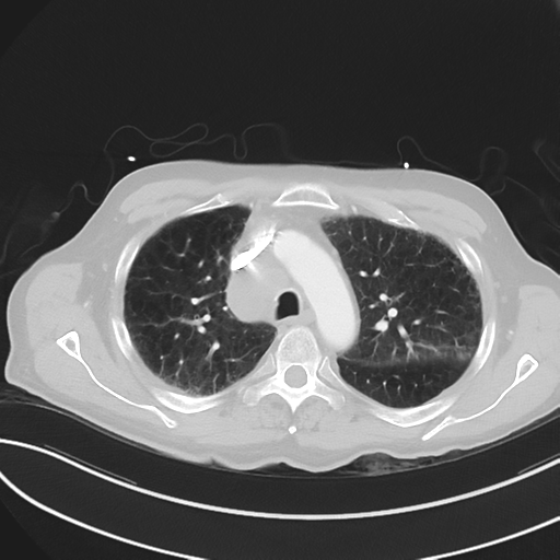 File:Brain metastasis (lung cancer) (Radiopaedia 48289-53180 Axial lung window 19).png