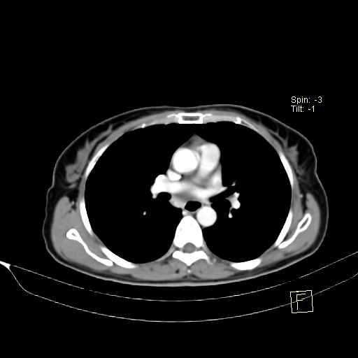 Brain metastasis as initial presentation of non-small cell lung cancer (Radiopaedia 65122-74127 A 23).jpg