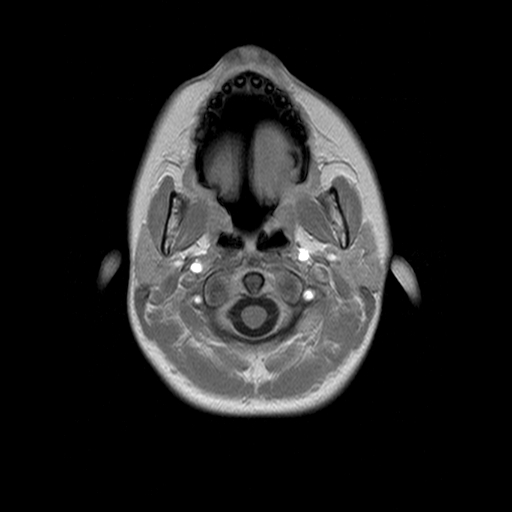 File:Brainstem ganglioglioma (Radiopaedia 10763-11224 Axial T1 C+ 17).jpg