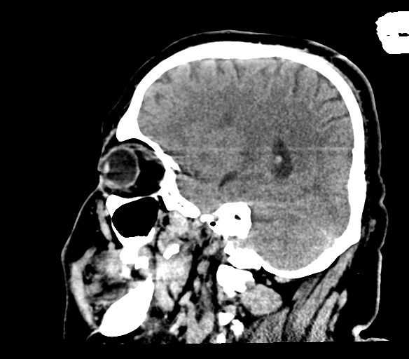 Brainstem hemorrhage (Radiopaedia 81294-94976 C 40).jpg