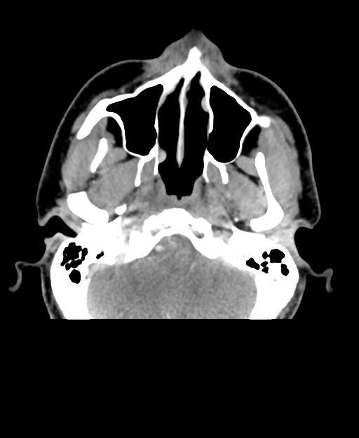 Branchial cleft cyst (Radiopaedia 31167-31875 Axial C+ delayed 4).jpg
