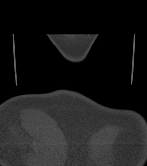 Branchial cleft cyst (Radiopaedia 31167-31875 Coronal bone window 67).jpg