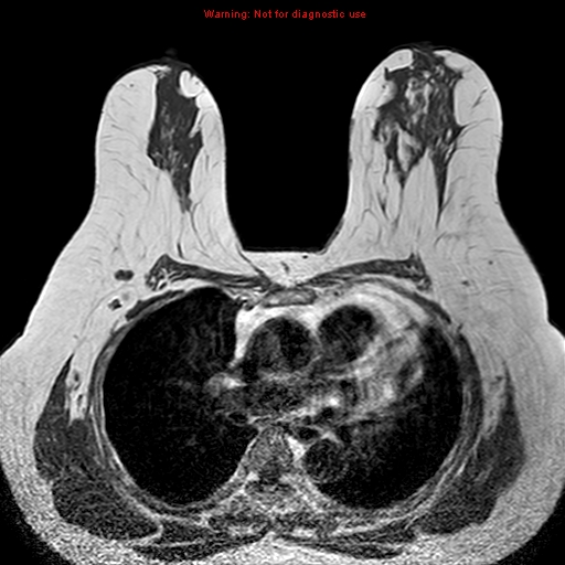 File:Breast carcinoma (multicentric multifocal in mammary Paget disease) (Radiopaedia 50966-56512 Axial T1 10).jpg