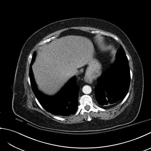 Breast carcinoma with pathological hip fracture (Radiopaedia 60314-67974 A 44).jpg