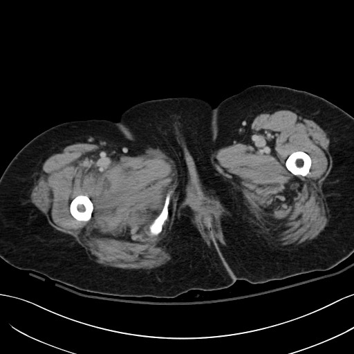 Breast carcinoma with pathological hip fracture (Radiopaedia 60314-67974 B 81).jpg