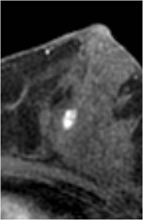 File:Breast fibroadenoma (Radiopaedia 13817-13695 MR Perfusion 3).jpg