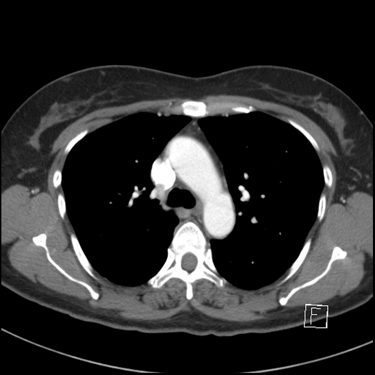 File:Breast metastases from renal cell cancer (Radiopaedia 79220-92225 A 34).jpg