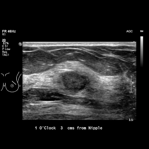 File:Breast metastases from renal cell cancer (Radiopaedia 79220-92226 Left breast US 3).jpeg