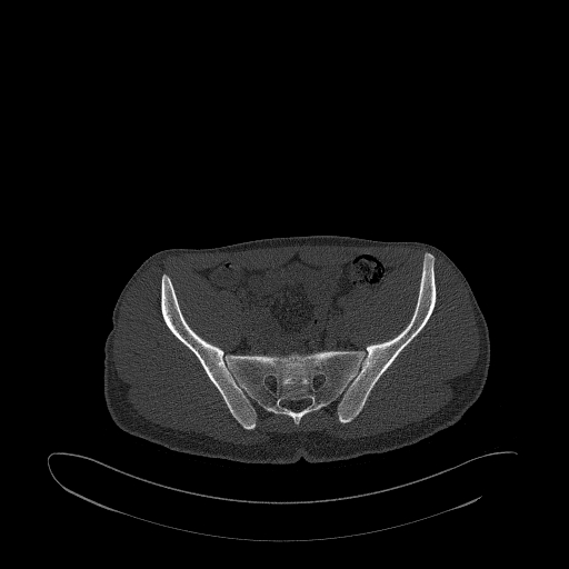 Brodie abscess- femoral neck (Radiopaedia 53862-59966 Axial bone window 58).jpg