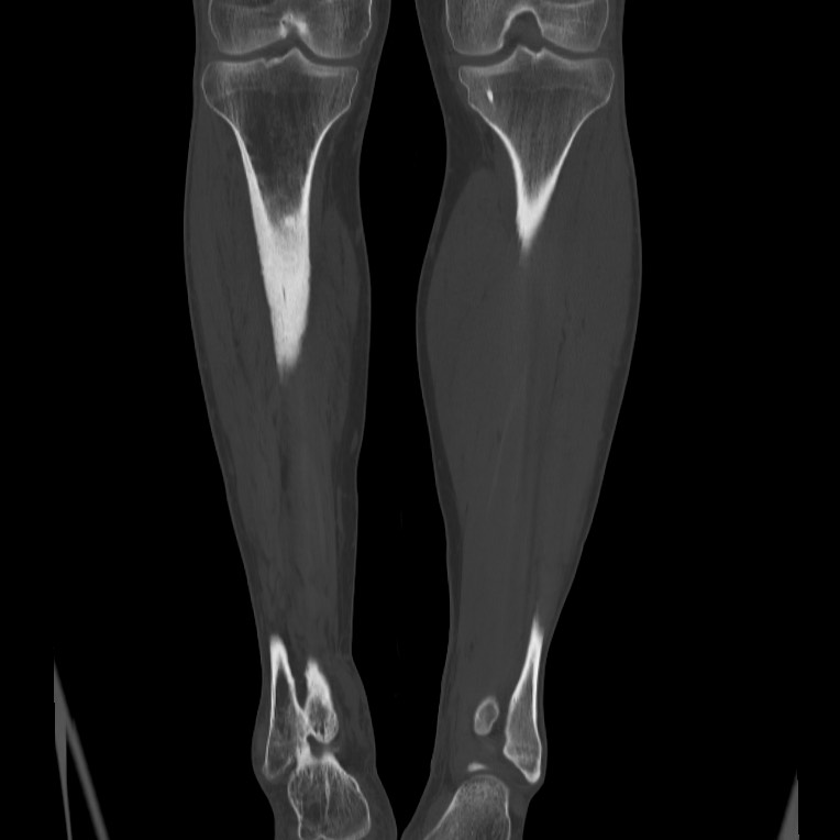 Brodie abscess - tibia (Radiopaedia 66028-75204 Coronal bone window 41).jpg