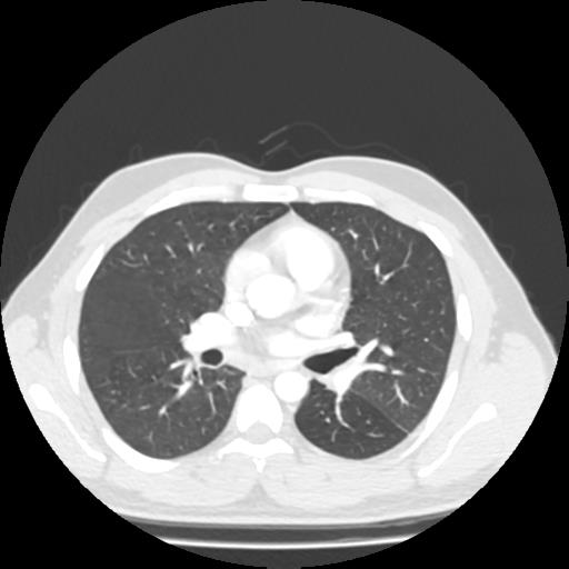 Bronchial carcinoid (Radiopaedia 80013-93291 Axial lung window 55).jpg