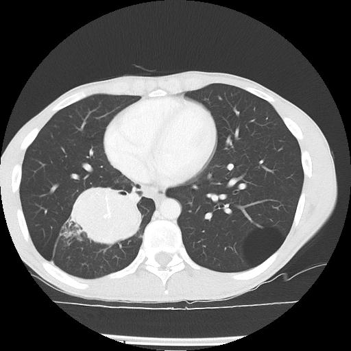 Bronchial carcinoid tumor causing right lower lobe collapse (Radiopaedia 83495-98594 Axial lung window 35).jpg