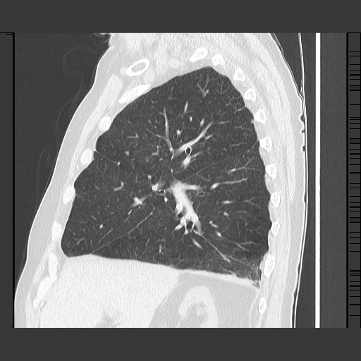 Bronchial stenosis - lung transplant (Radiopaedia 73133-83848 Sagittal lung window 24).jpg